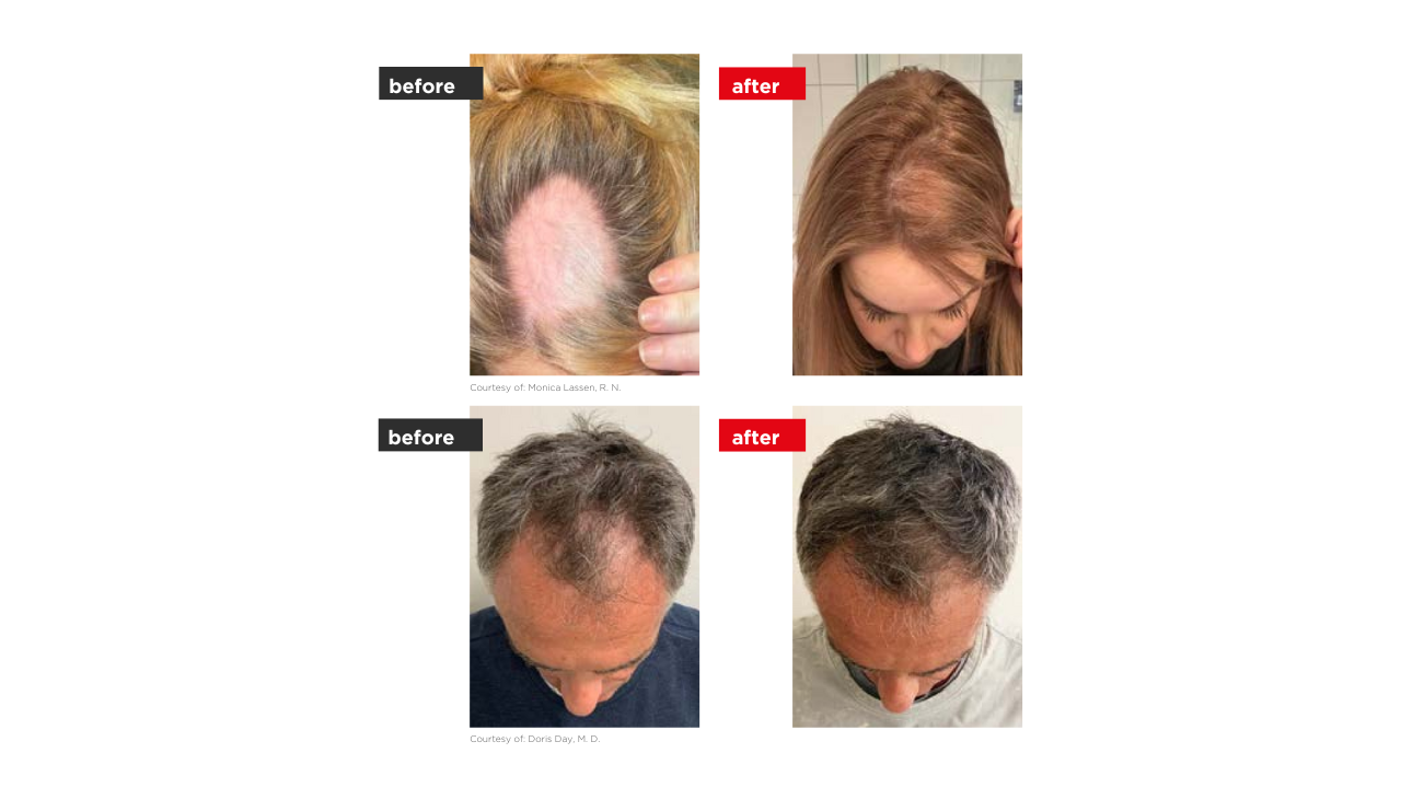 HairRestart elotte utana