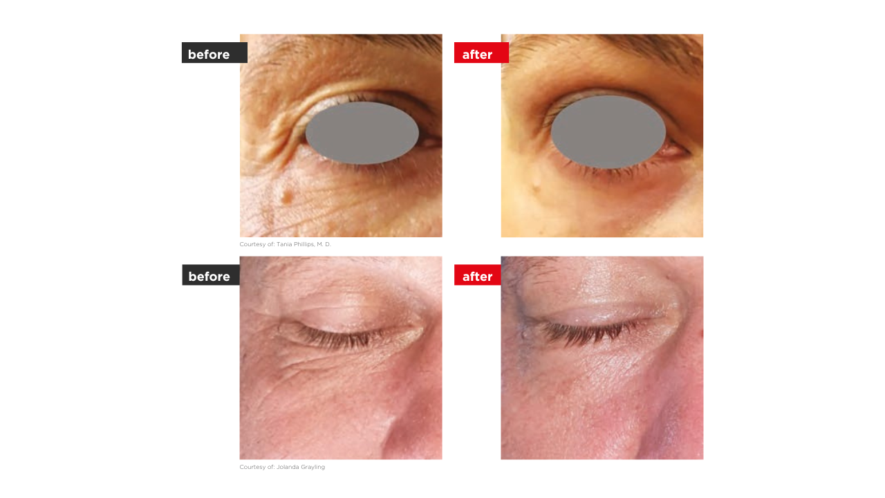 SmoothEye előtte utána