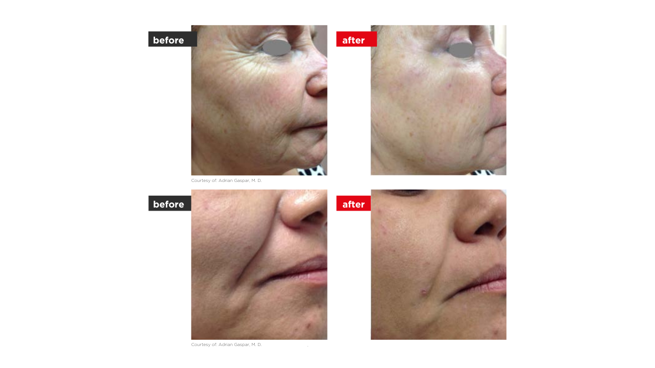 Fotona 3D elotte utana