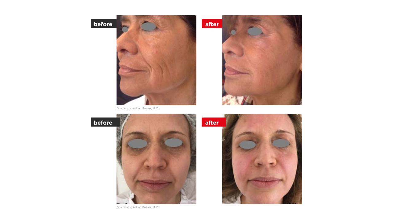 Fotona 4D elotte utana