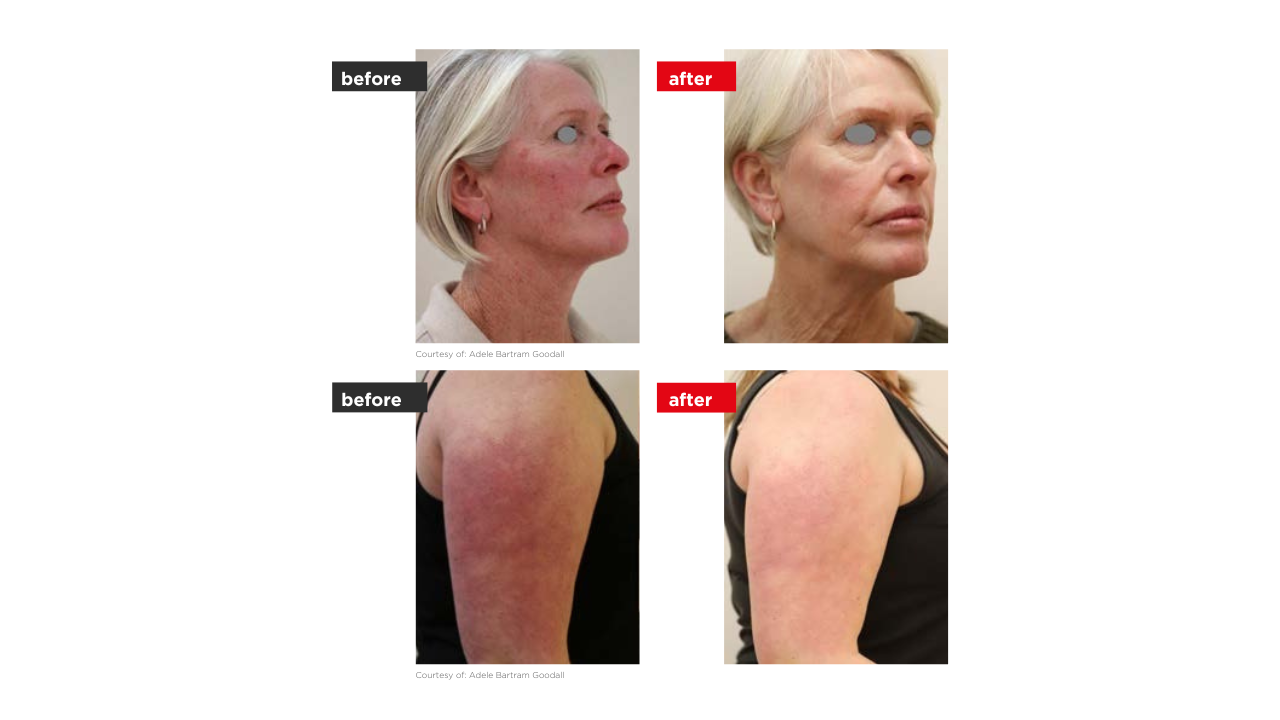 Rosacea kezelés előtt és után